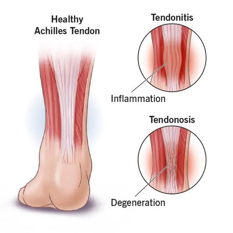 What is Achilles Tendonitis
