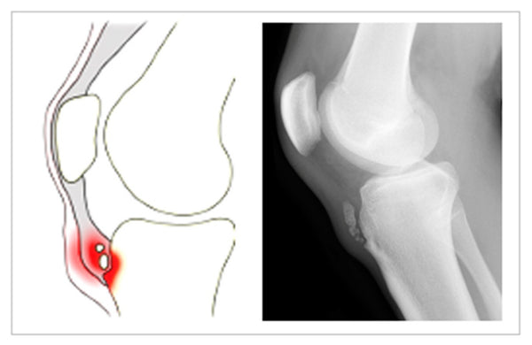 Osgood Schallater's, Growing Pains, Bump under knee cap in kids