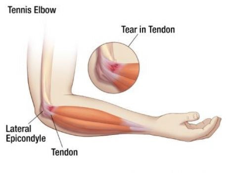 Tennis Elbow Pain, Elbow Pain, Tennis Elbow Strap