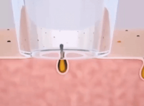 Blackhead Remover Extractor Tool