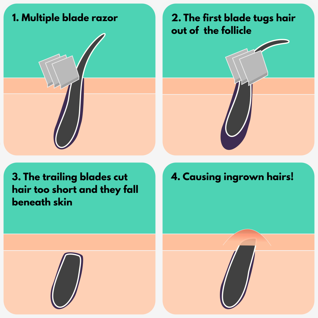 Info graphic showing how a multiple blade razors tugs and pulls on hair cutting it to short, resulting in ingrown hairs