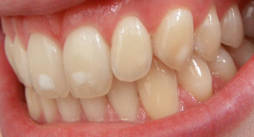 dental-fluorosis