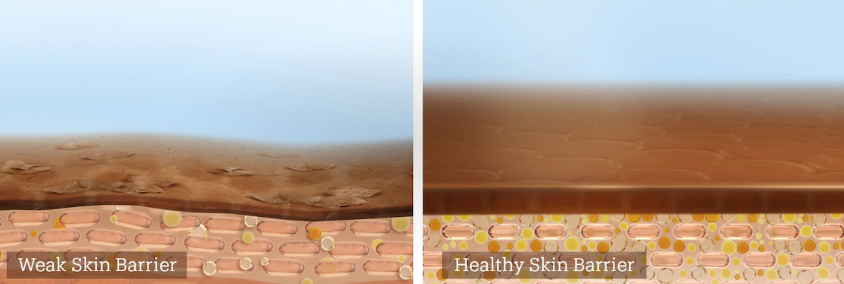 healthy vs weak skin barrier