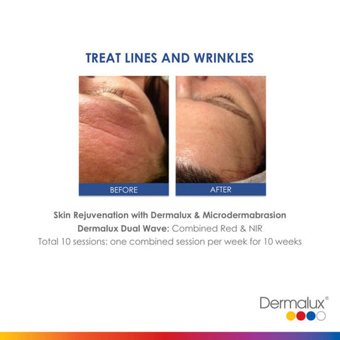 Treating Fine Lines and Wrinkles - Lé Salon Medi Spa - Dermalux LED
