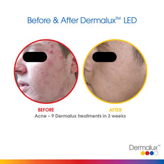 Treating Acne - Lé Salon Medi Spa - Dermalux LED