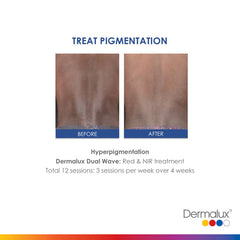 Treating Pigmentation - Lé Salon Medi Spa - Dermalux LED