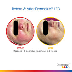 Treating Acne and Rosacea - Lé Salon Medi Spa - Dermalux LD