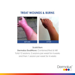Treating Wounds and Burns - Lé Salon Medi Spa - Dermalux LED