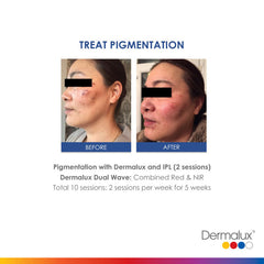 Pigmentation - Lé Salon Medi Spa - Dermalux