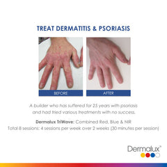 Treating Dermatitis and Psoriasis - Dermalux LED - Lé Salon Medi Spa