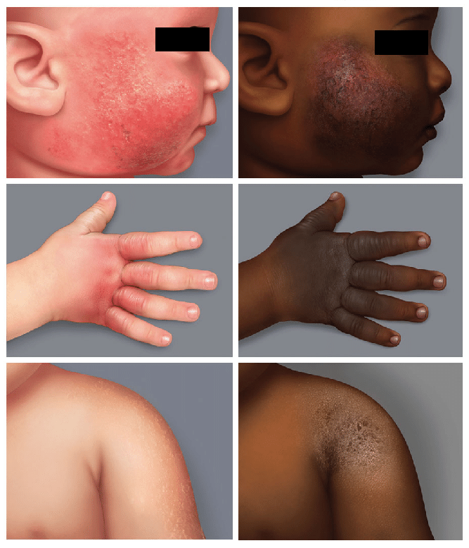 eczema on dark vs light skin