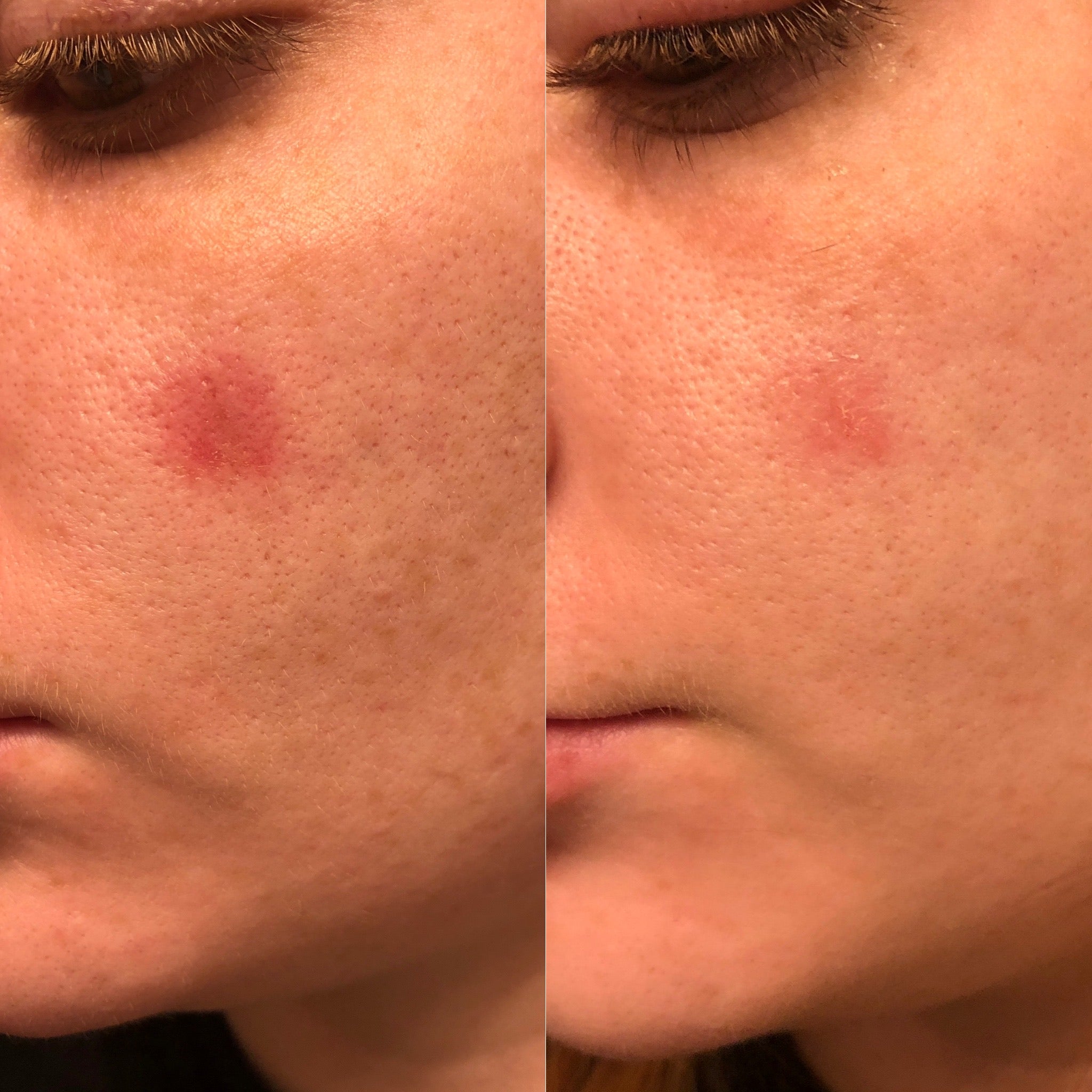 before and after from use of MSM gel, skin wound is healed 3 days later