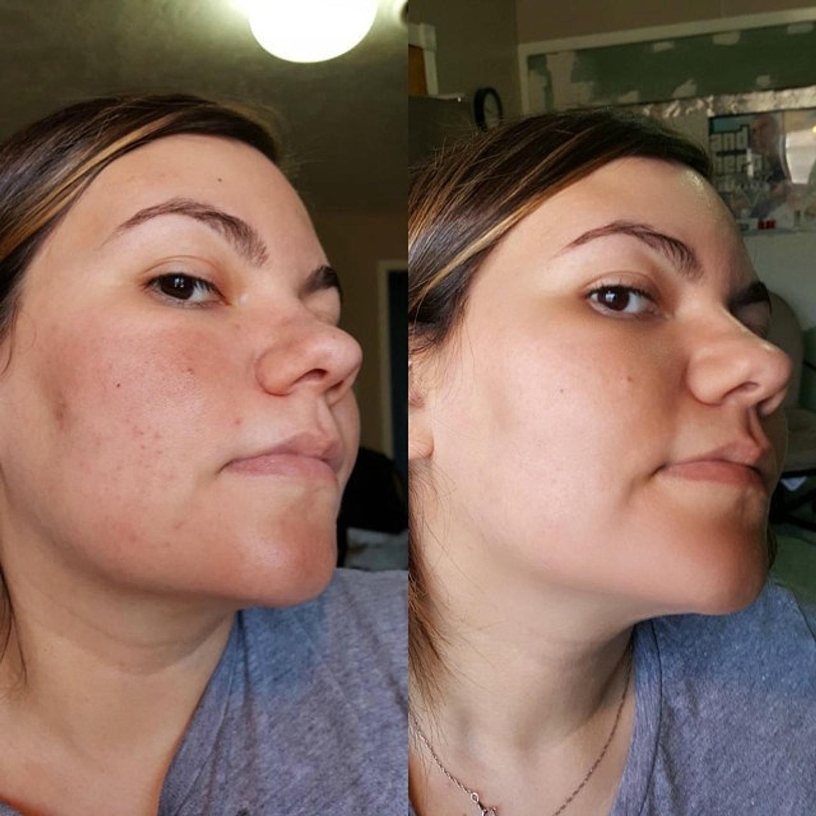 before and after of rosacea redness on females face from use of the MSM cream