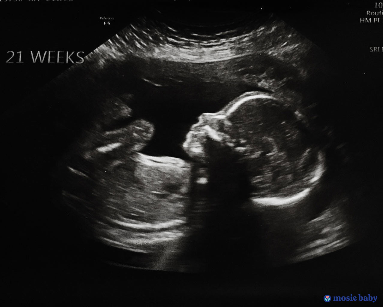 21 week sonogram