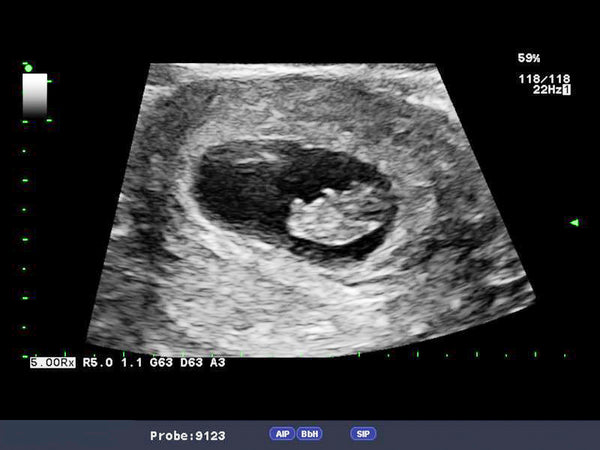 home insemination success sonogram