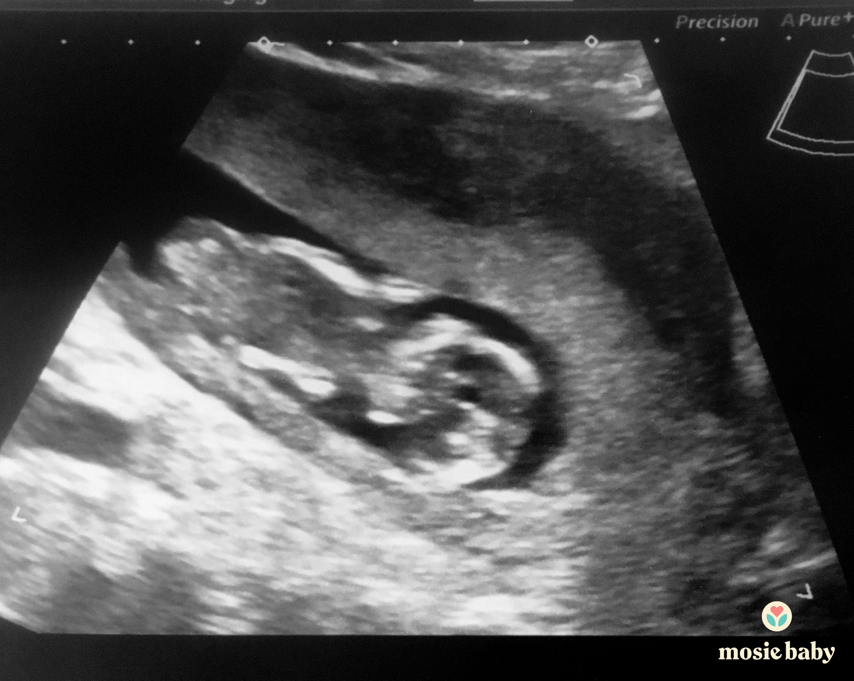 sonogram of a mosie baby