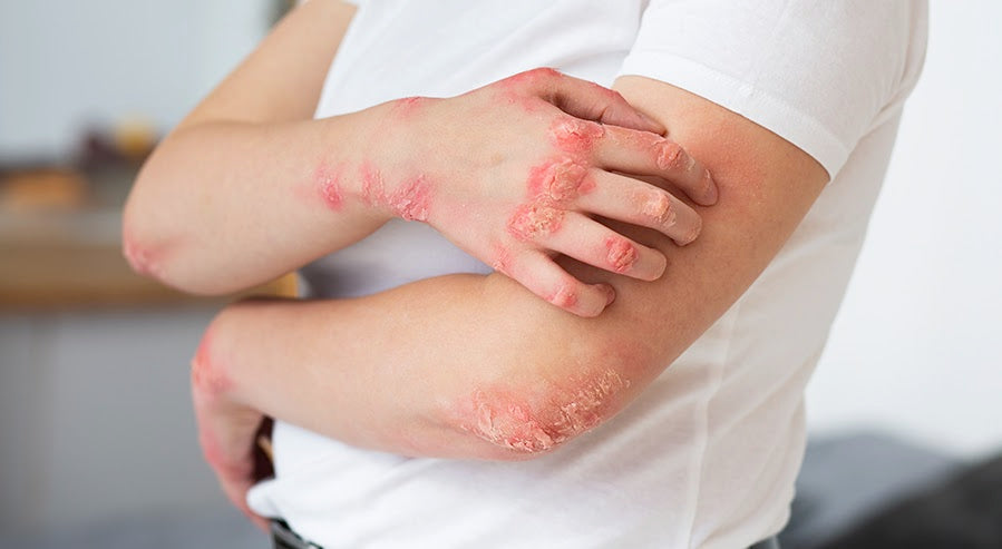 A Case of Eczema