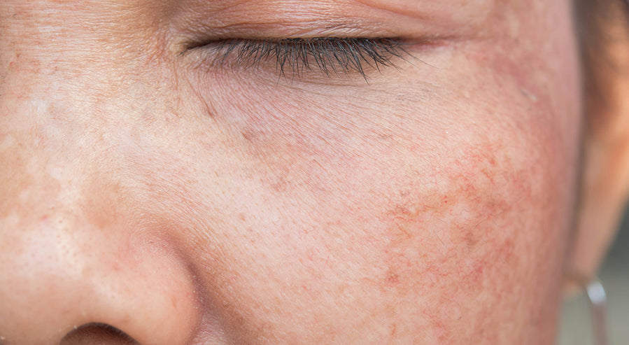 A Case of Hyperpigmentation