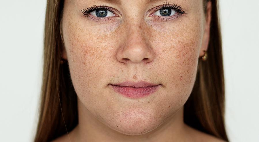 A Case of Hyperpigmentation