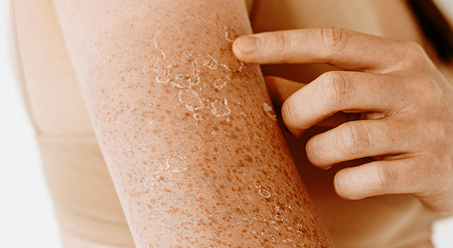 A Damaged Skin Barrier