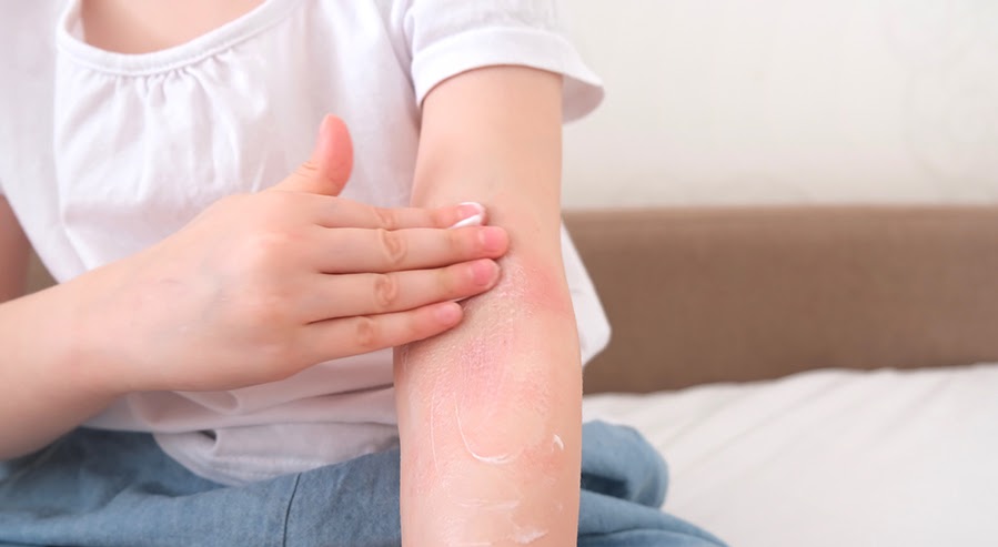 A Person Managing Their Symptoms of Eczema