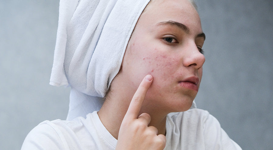 A Person With Acne
