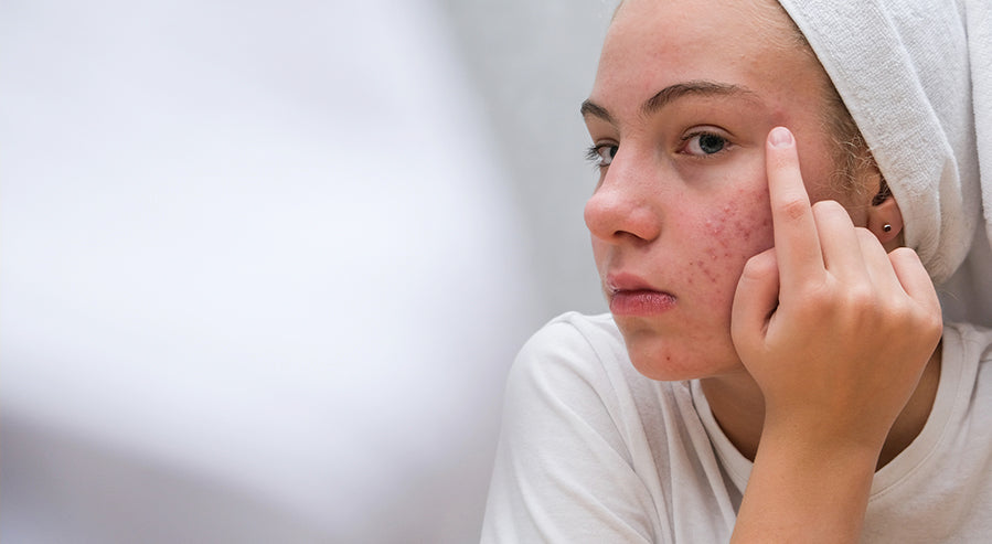 A Woman Examining Face Acne Scars