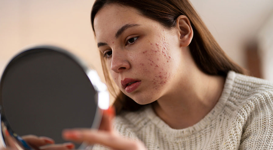 A Woman Examining Her Facial Acne