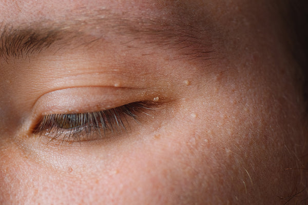 woman with bumps on her face