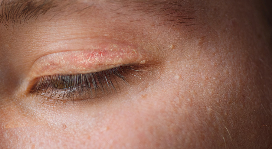 Eyelid Eczema