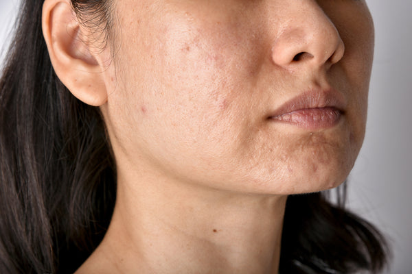 woman with oily skin