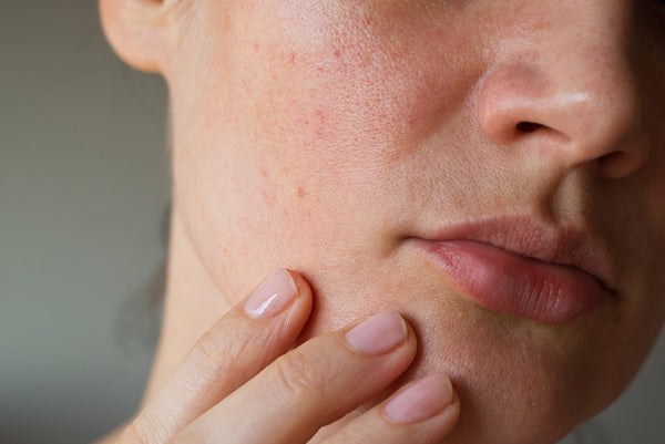 woman with dry, red skin