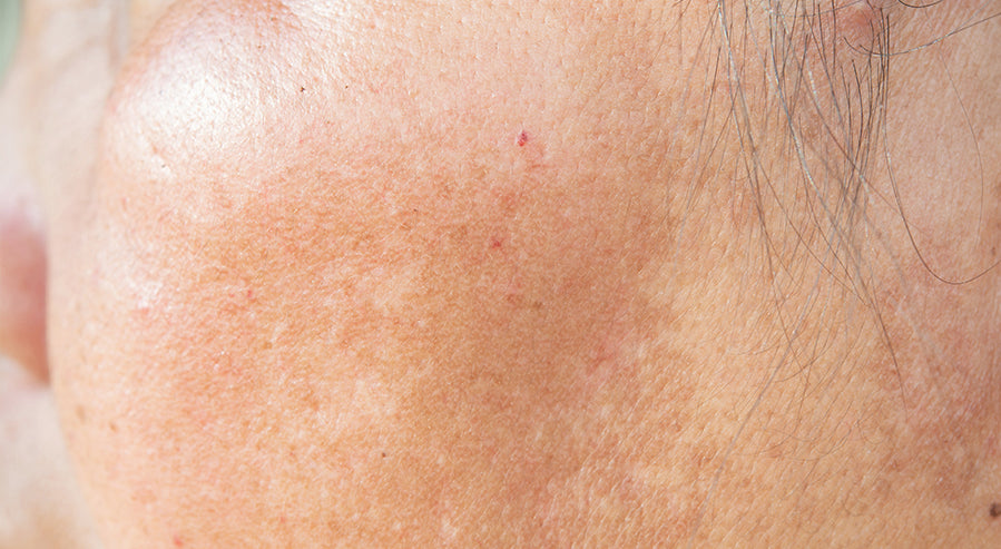Skin Dark Spots