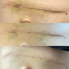 Scar results from Magic Gel