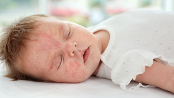 A young baby with a rash on its face lies on a white sheet after using some of the best ingredients for baby eczema