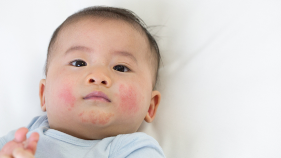 A baby with dry, red cheeks - one of the common symptoms of baby eczema