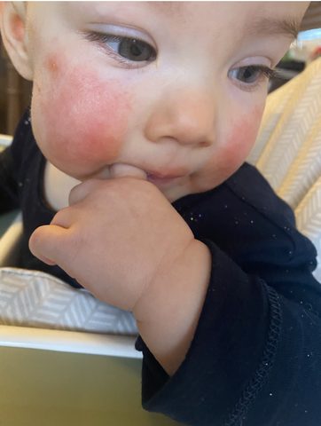 A baby with red cheeks, one of the common symptoms of baby eczema