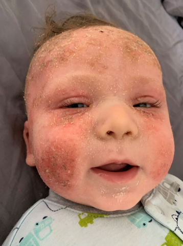 A baby with red, flaky cheeks and displaying severe symptoms of baby eczema