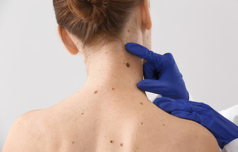 mole removal spot behind a neck
