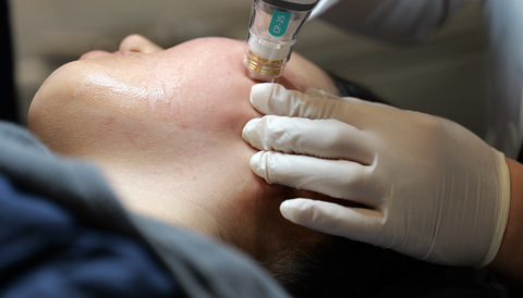Potenza Treatment for Acne in Korea