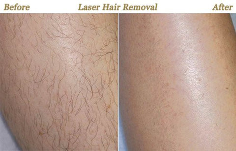 All About Laser Hair Removal Cost Pain And More