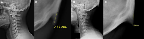 (A,B) Images of a participant from Group A; (C,D) a participant from Group B. (B,D) An enlarged representation of the area surrounding and including the EEOP in (A,C), respectively. (B,D) These images include a measurement line indicating the origin, tip and length of the EEOP.