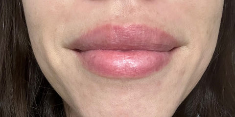 After Treatment of Perioral Dermatitis with R3 Derma Pro Organic Aloe Gel