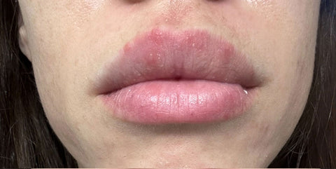 Before - Perioral Dermatitis