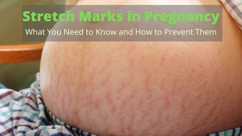 Stretch Marks in Pregnancy: What You Need to Know and How to Prevent Them