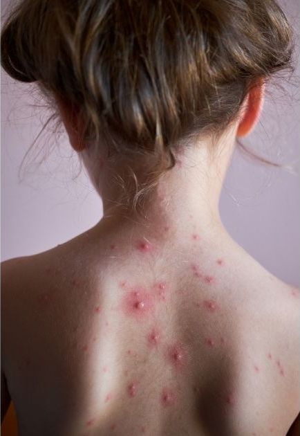 woman with back acne