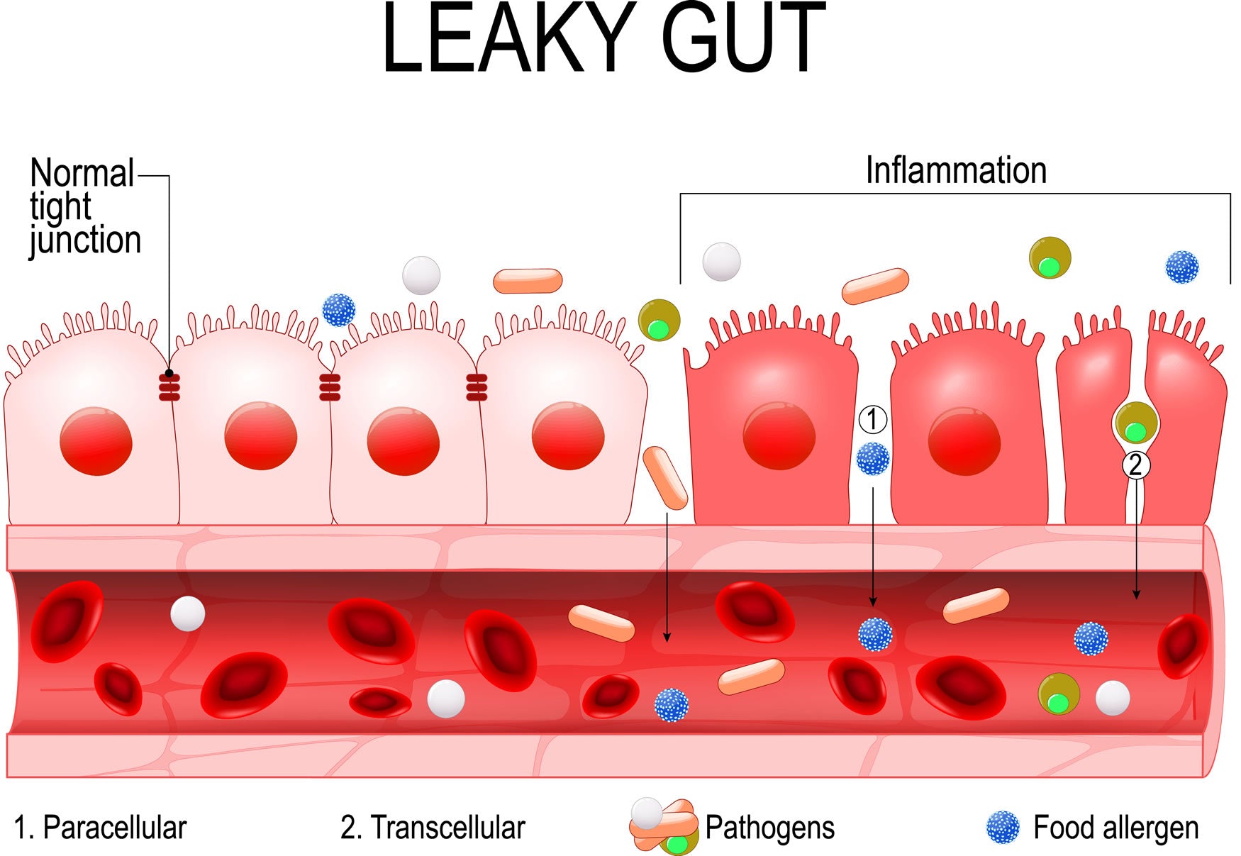 Diagram of Leaky Gut vs Healthy Gut