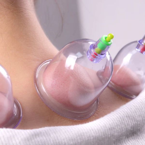 cupping