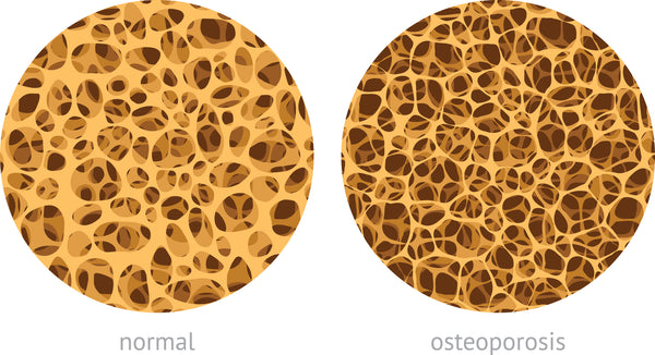 osteoporotic bones are porous, weak, and brittle