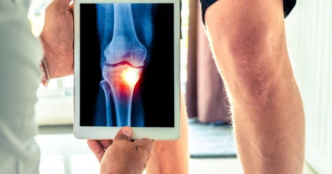 Osteoarthritis patients commonly experience painful and swollen joints due to a lack of cartilage between the joints. 